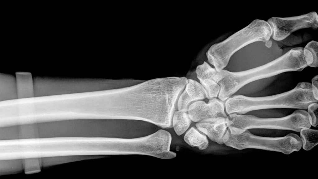 How Much Does Disability Pay for Rheumatoid Arthritis?
