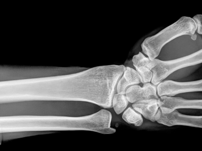 How Much Does Disability Pay for Rheumatoid Arthritis?