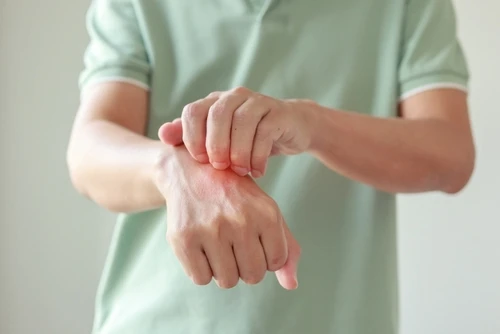 Is Psoriasis a Disability?